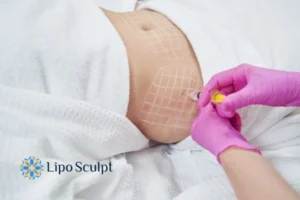 Are The Results From Aqualyx Permanent? 1 Do you want to know how long Aqualyx Kirkstall results last?