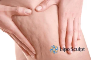 CoolSculpting for Legs: The Innovative Approach to Redefining Your Legs 5 Start your journey today book your coolsculpting treatment Kirkstall online today!